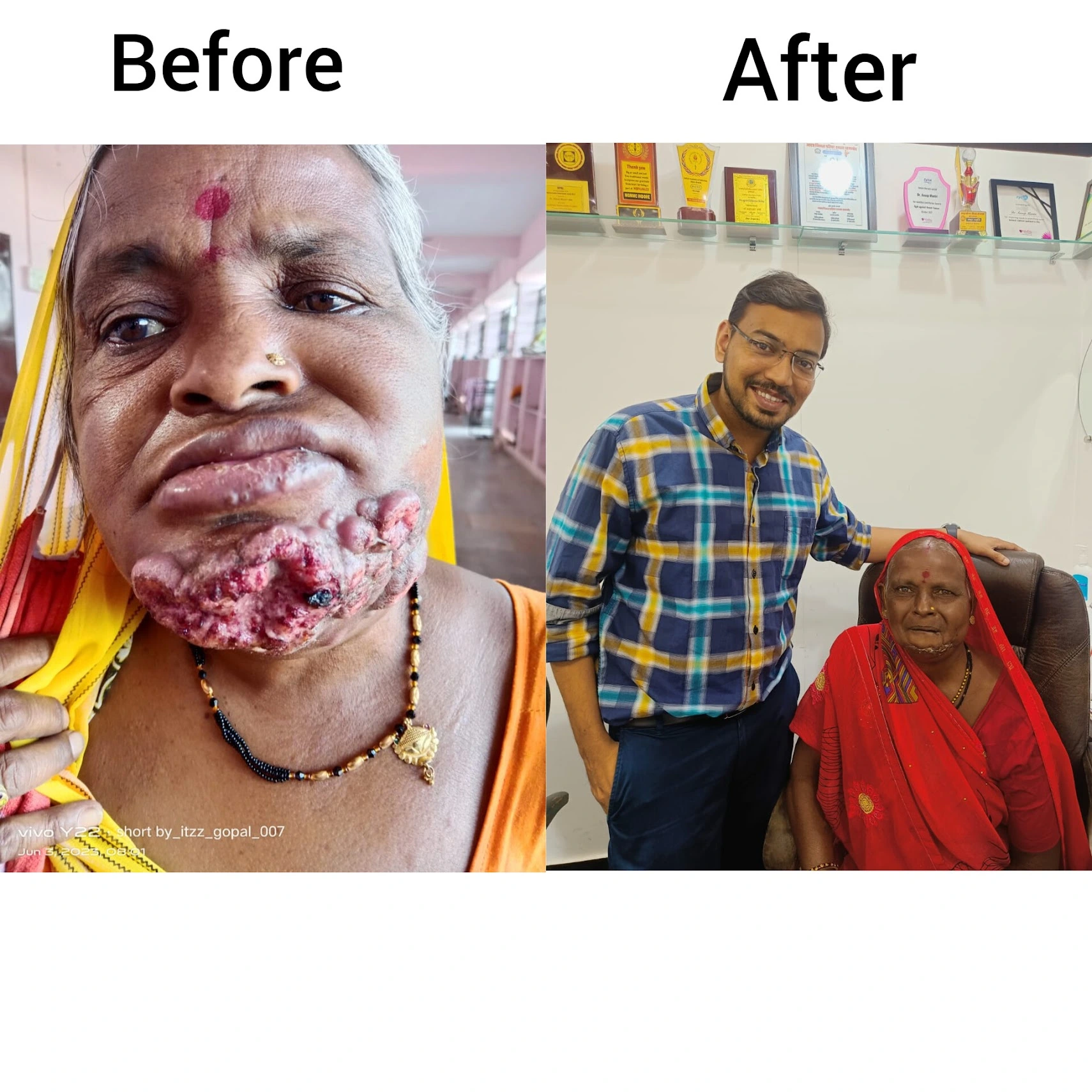 before after cancer treatment by dr. anoop mantri
