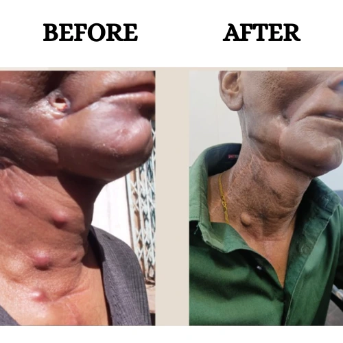 before after cancer treatment by dr. anoop